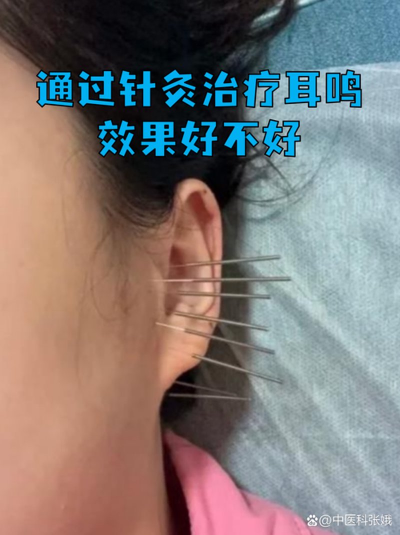 耳鸣治疗